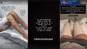 Imágenes de las piernas con quemaduras de segundo grado y parte del comunicado difundido en redes sociales por la misma Adara.