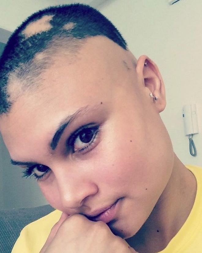 Mujer con alopecia 1