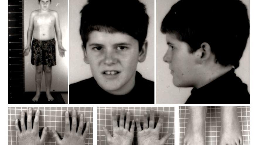 Fenotipo del síndrome de Prader-Willi, a los 15 años de edad con ausencia de los rasgos faciales típicos del SPW