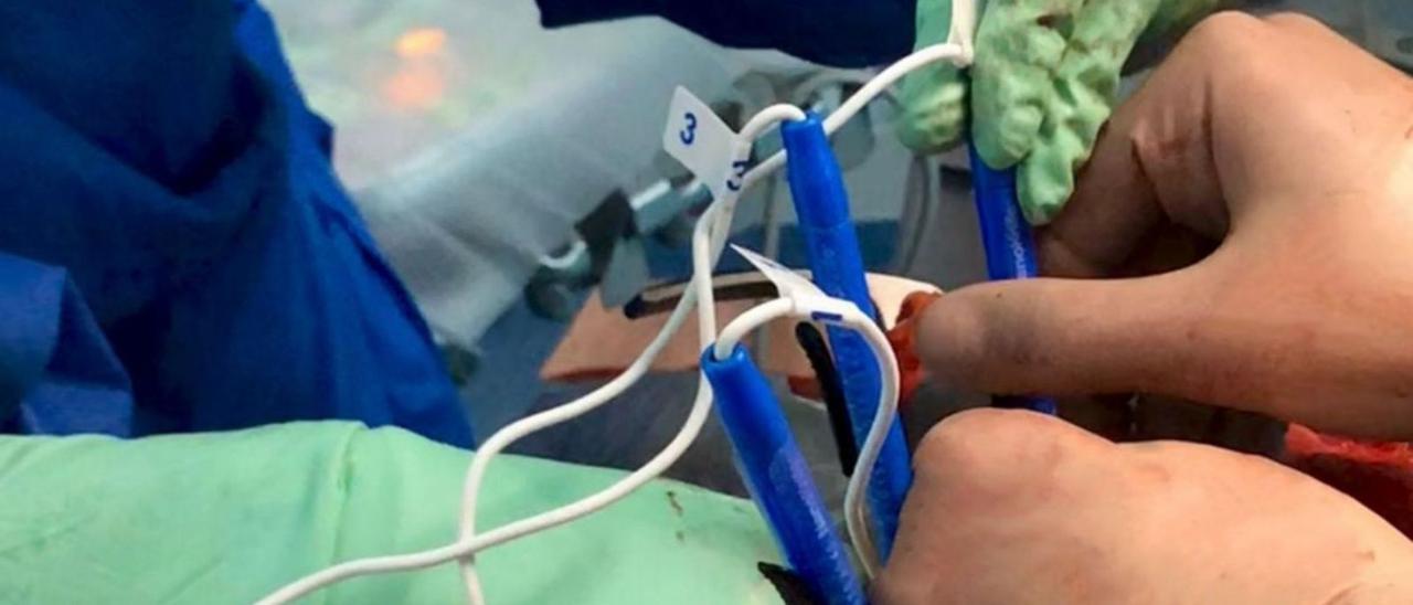 Un momento de la operación realizada con la nueva técnica en el hospital Doctor José Molina Orosa. | | SANIDAD