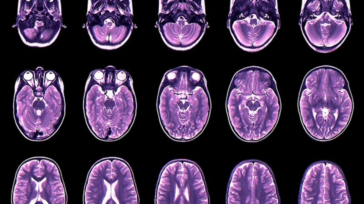 Los investigadores han creado gráficos de crecimiento cerebral que cubren toda la vida humana, agregando más de 120.000 escaneos.