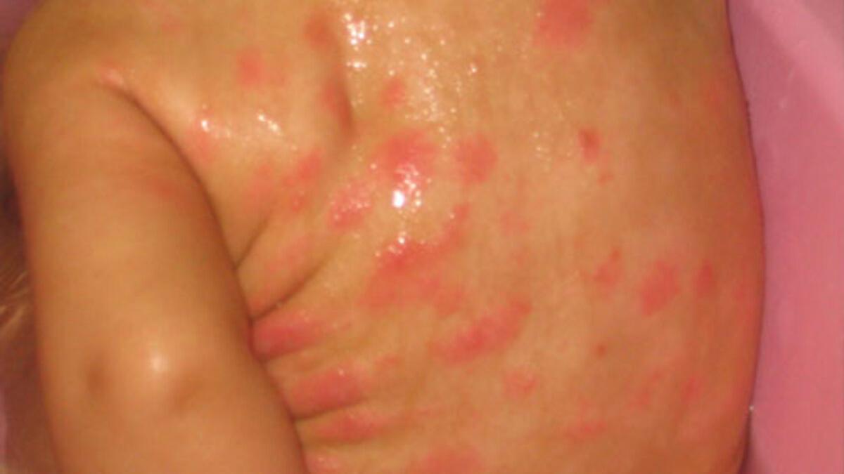 Dermatitis seborreica en bebés: causas, síntomas, cómo identificarla y  tratamiento