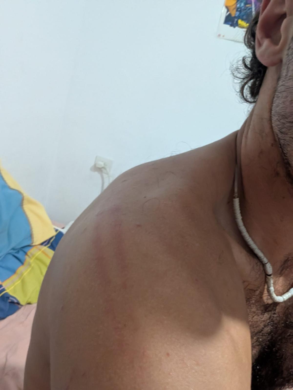 Una de las marcas que tiene Biel Garau en el hombro a raíz de los porrazos en las cargas policiales.
