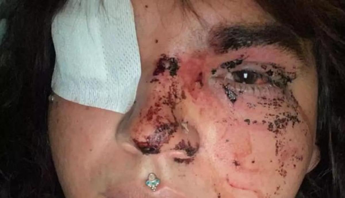 La cara de Bianca Lilibeth Fernández després de ser agredida a La Bañeza