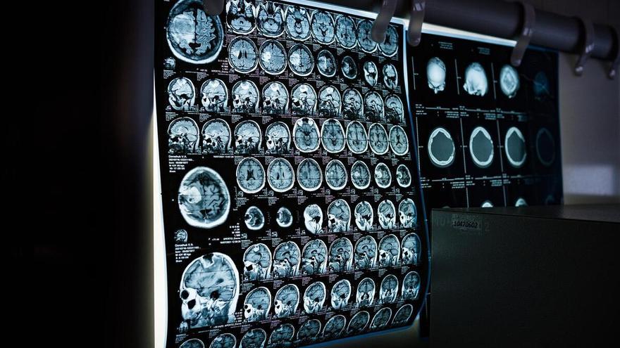 Una nueva técnica permite la detección precoz del alzhéimer con un 98% de fiabilidad