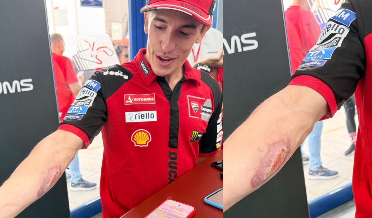 El brazo de Marc Márquez un mes después de COTA