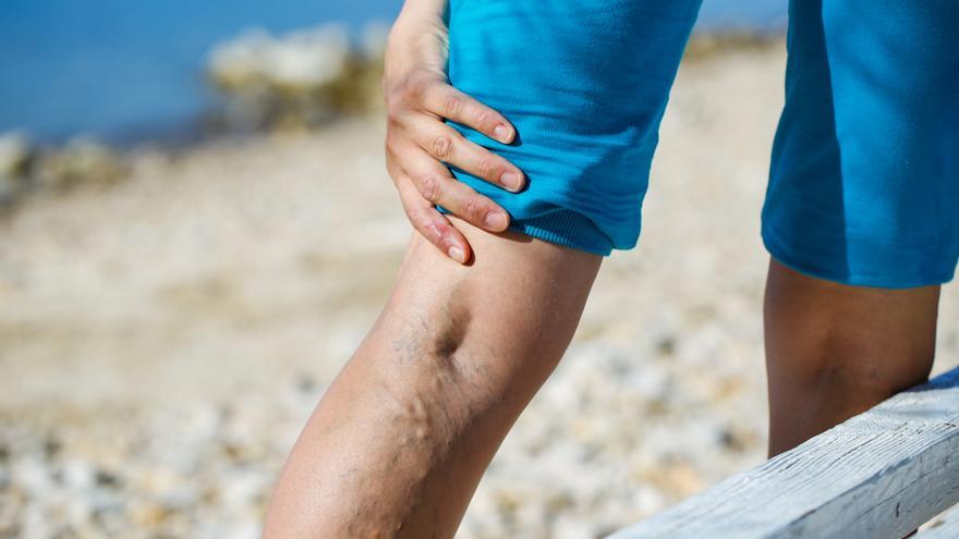 Los tratamientos más avanzados para eliminar varices, hemorroides y fisuras