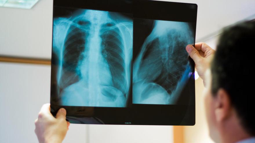Los cánceres de hueso se diagnostican con una radiografía.