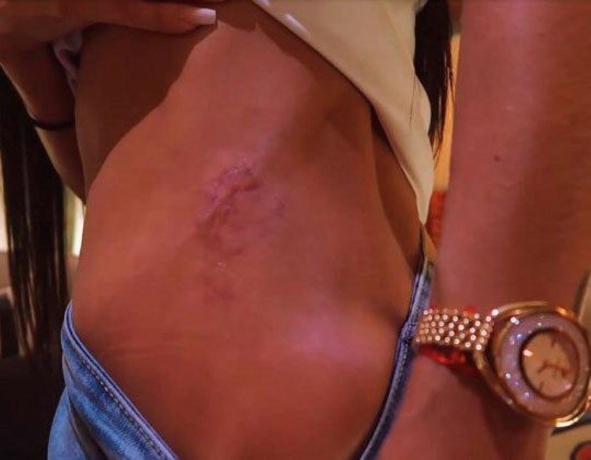 Aurah Ruiz enseña la cicatriz que se le ha quedado de su última operación estética