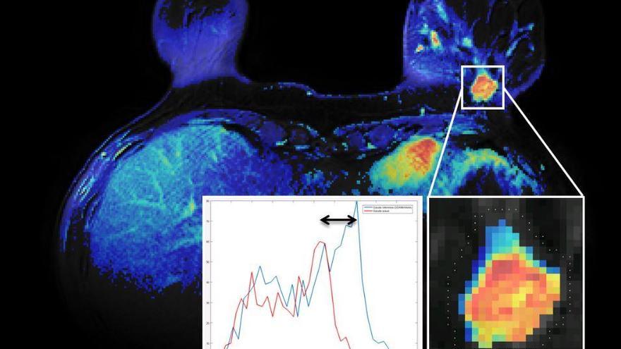 La radioterapia intraoperatoria suprime las sesiones de radioterapia externas de cáncer de mama