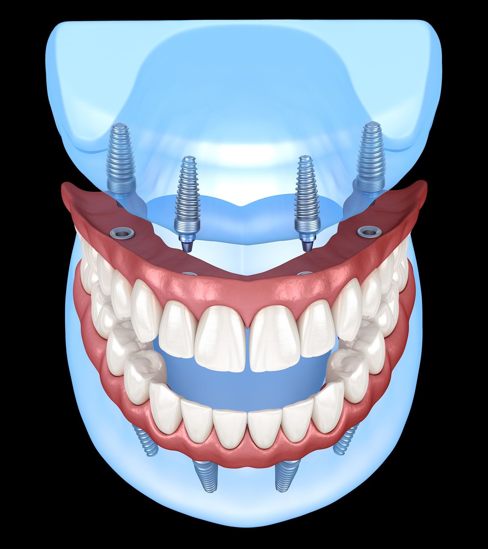 IGB Dental, expertos en implantes y dientes fijos en un día