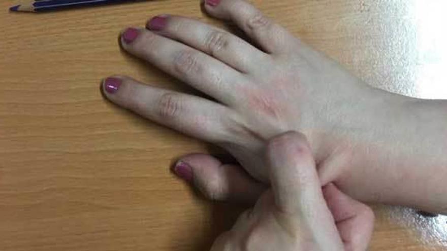 Una simulación de cómo se realizan las heridas en las manos.