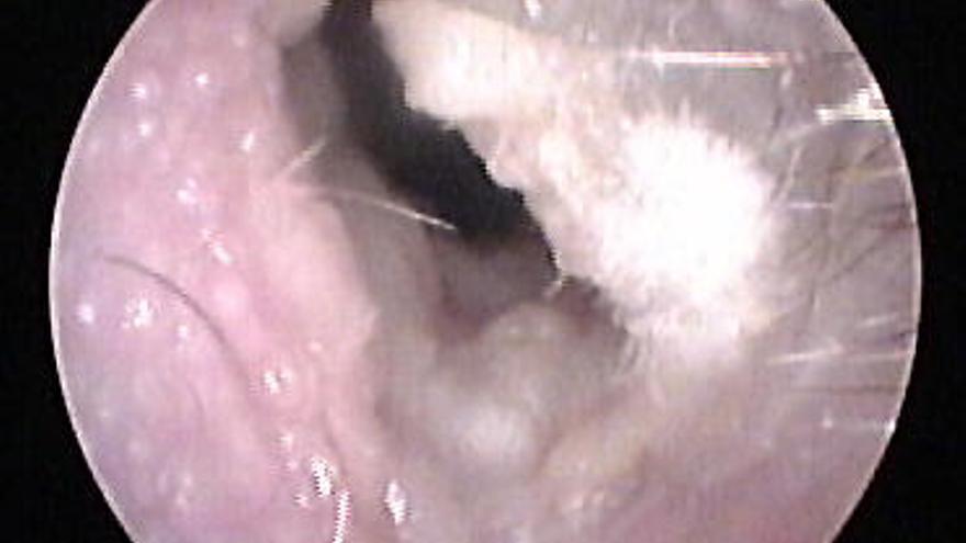 Otitis externa