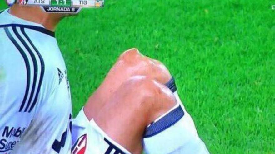 Espeluznante lesión del portero Ustari, ex del Getafe y el Almería