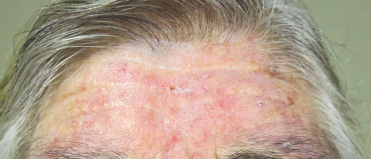 Así es! La dermatitis seborreica es un trastorno muy frecuente de la piel,  puedes identificarla por una caspa persistente, piel enrojecida…