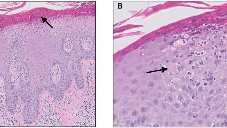 Micrografía de una psoriasis vulgaris