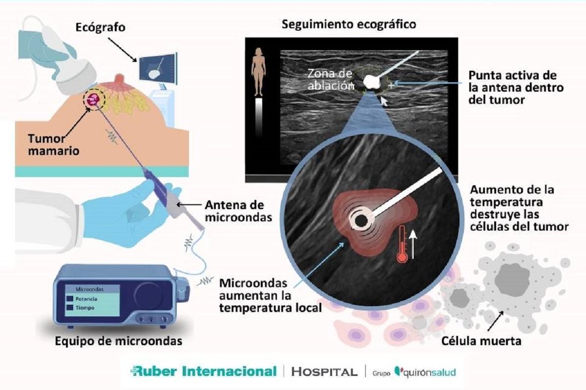 La termoablación por microondas solo puede aplicarse en determinados casos.