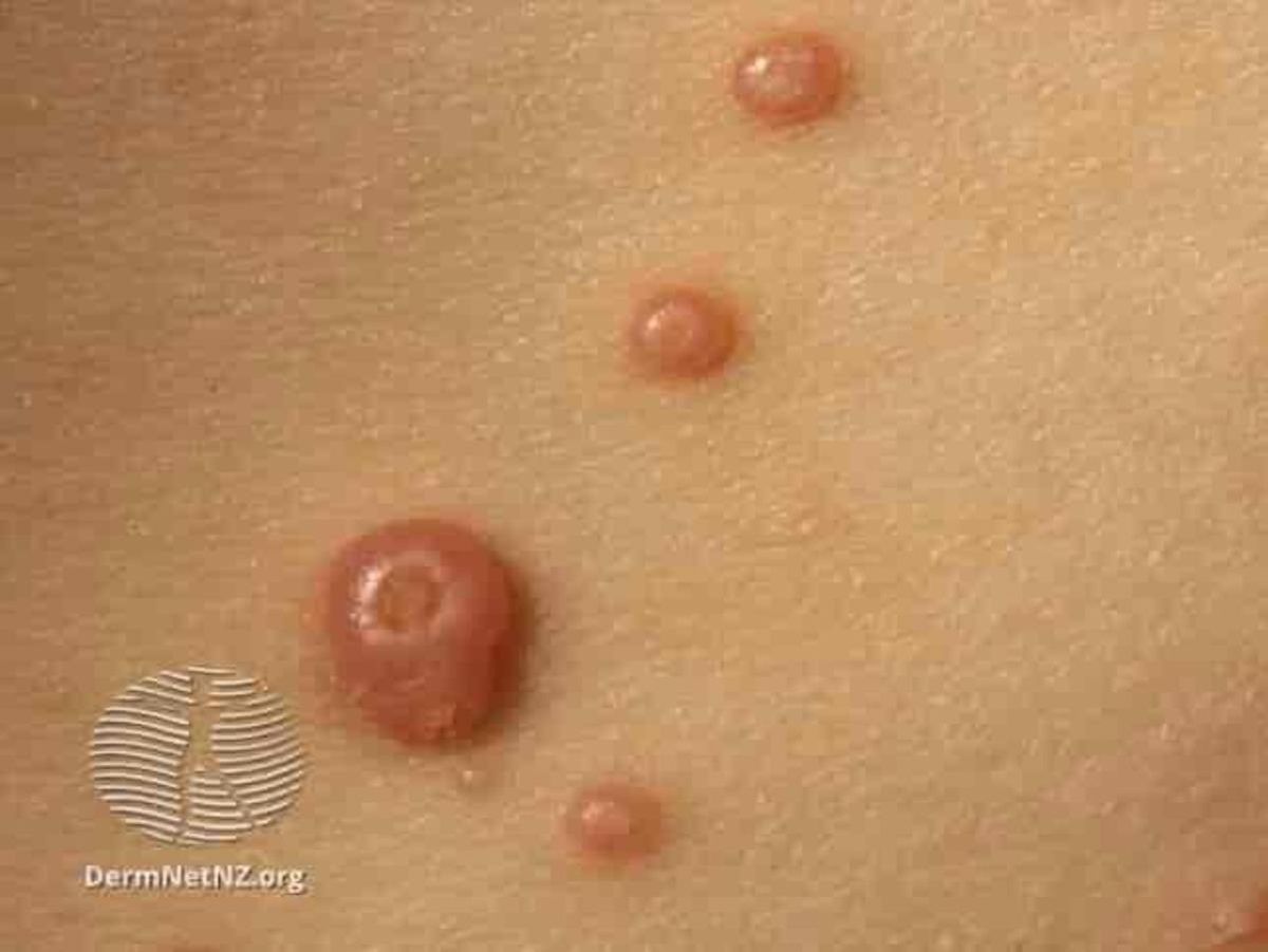 El molusco contagioso es un tipo de enfermedad de la piel que se caracteriza por protuberancias en la piel que tienen una pequeña depresión en el centro.
