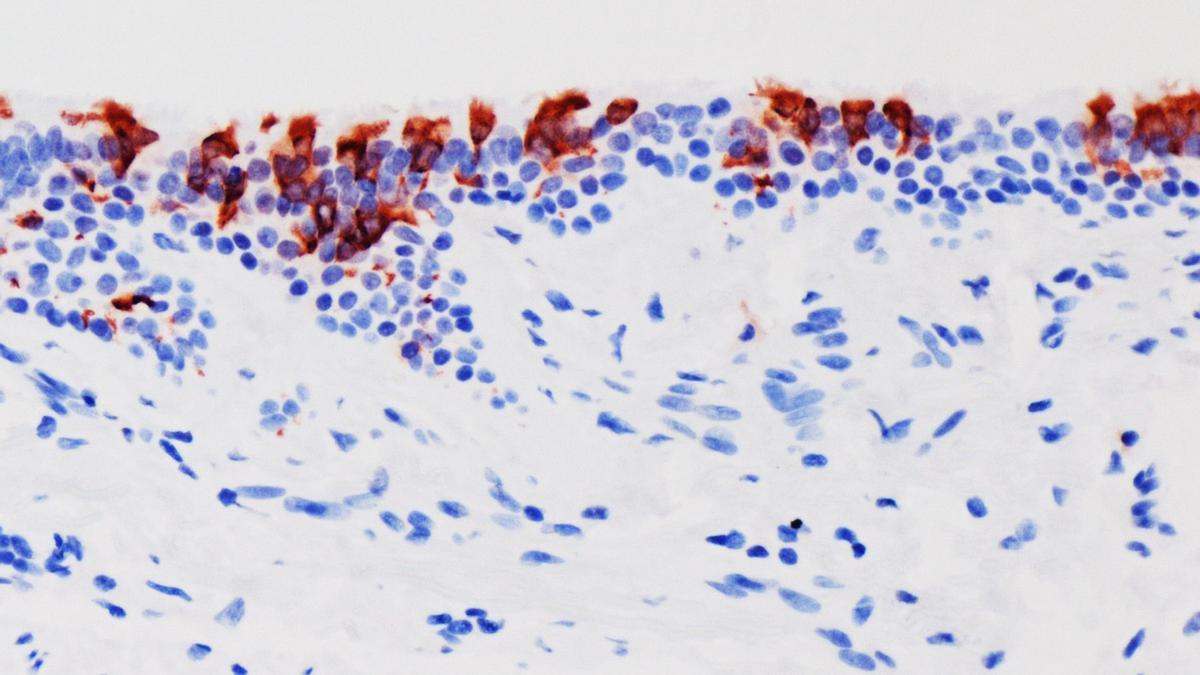 La variante omicrón del SARS-CoV-2 (en rojo) infectando tejidos de bronquios humanos.