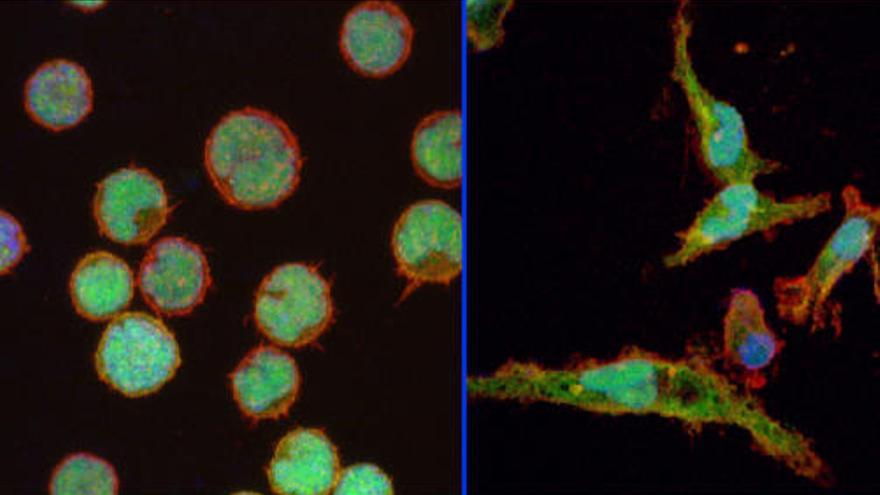 Linfocitos cancerígenos reprogramados en macrófagos.