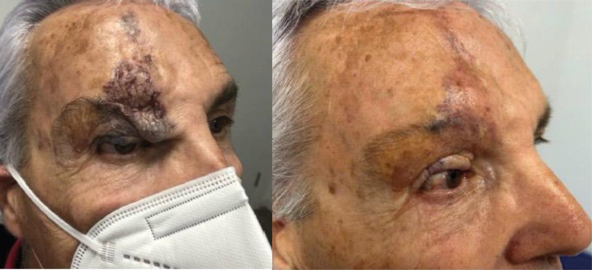 Un paciente con una malformación vascular, antes y después de la cirugía.