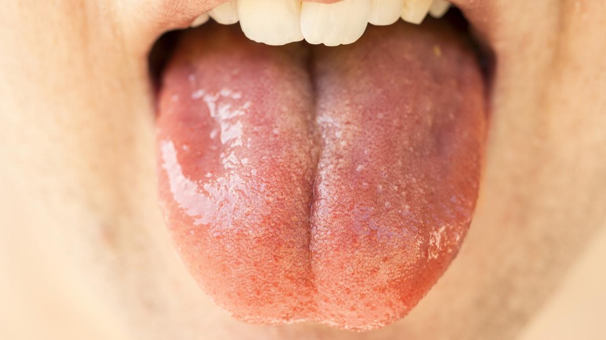 ¿Qué es la 'lengua COVID'? Descubre un síntoma poco común del coronavirus