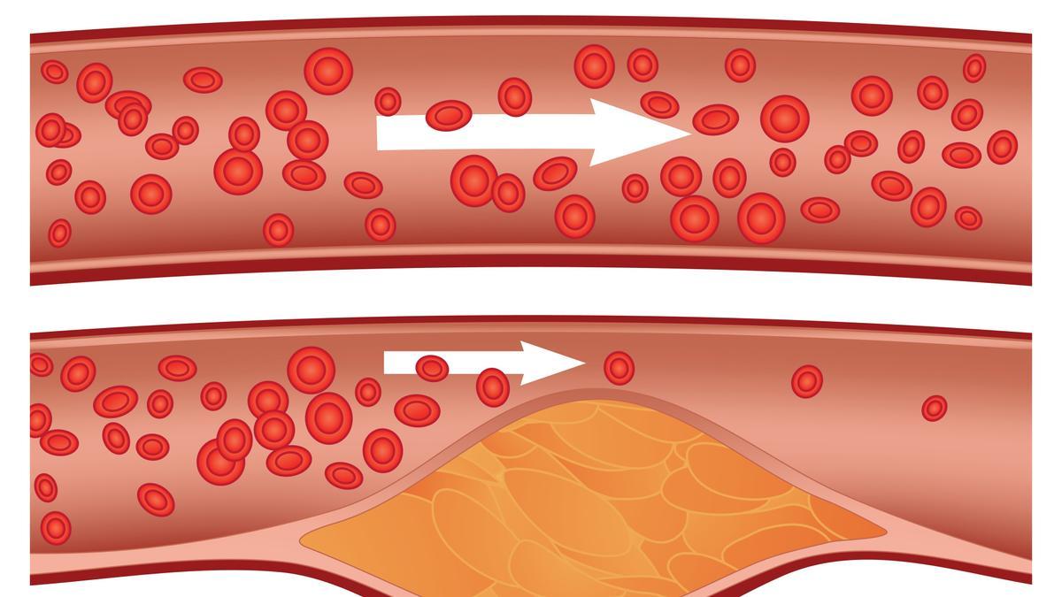 Archivo - Niveles de colesterol en la sangre