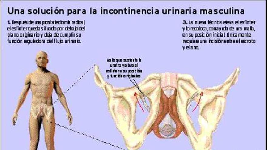 La nueva técnica para la incontinencia urinaria masculina promete una  eficacia del 80% - La Nueva España