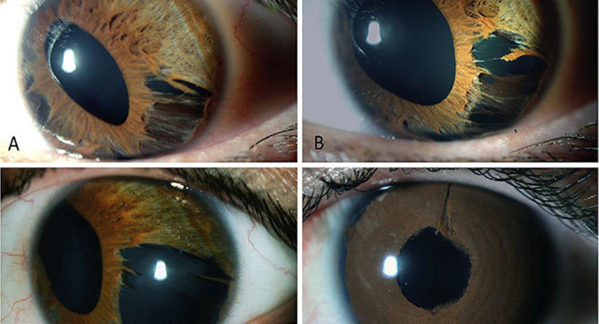 Cambiar el color de tus ojos es posible. Vissum te explica cómo