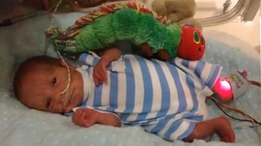 Michelle Moloney nació con 26 semanas y ya tiene un año