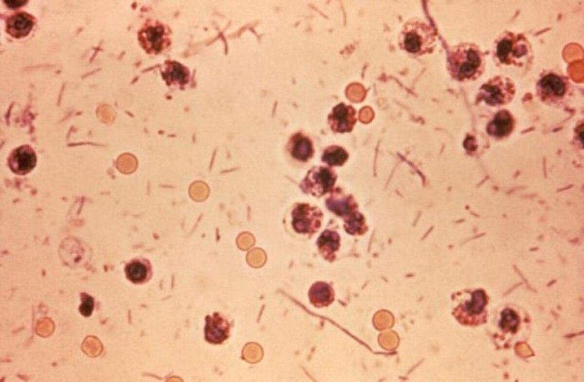 Imagen de una infección por shigelosis