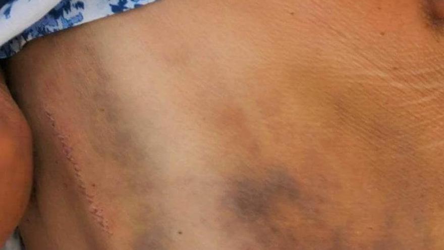 Los hematomas que sufrió la víctima