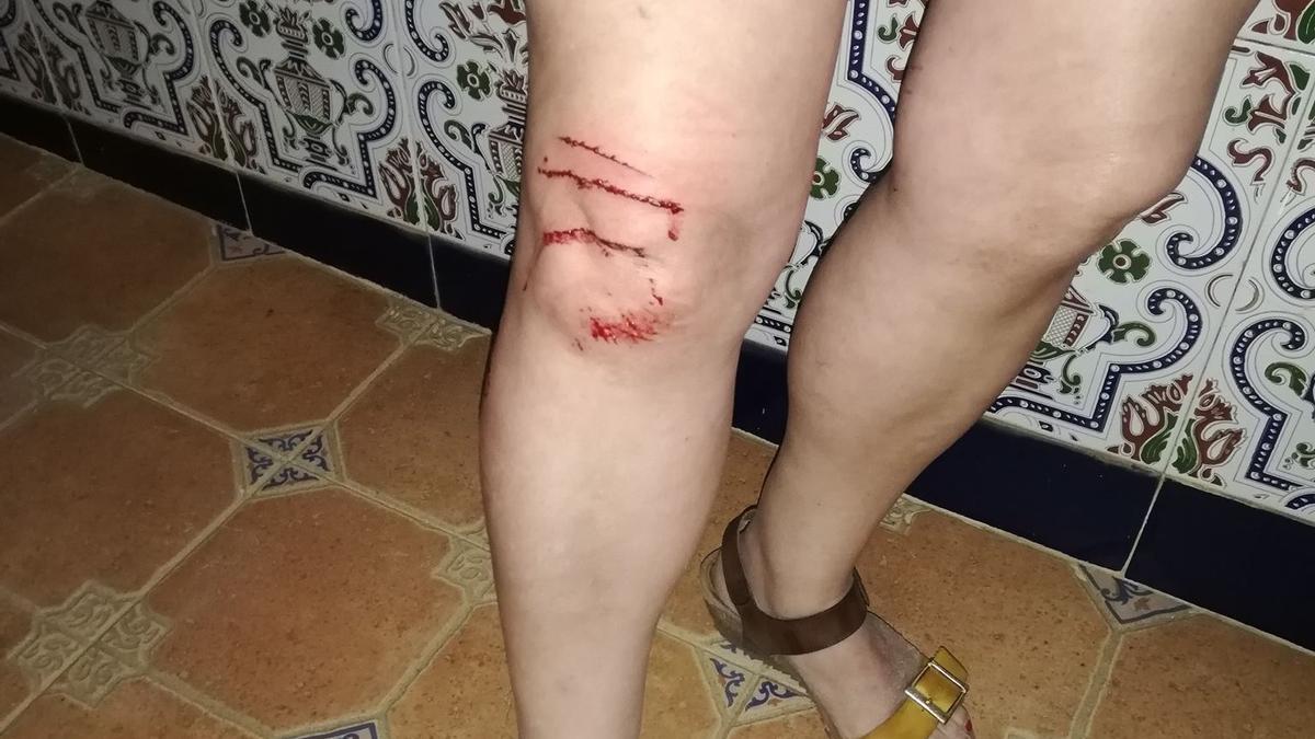 Una de las mujeres, con heridas en las piernas tras el ataque.