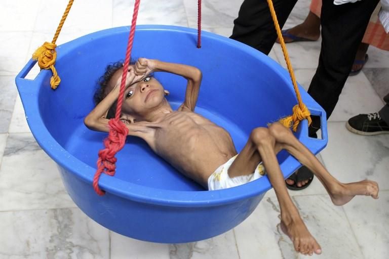 Un niño yemení que sufre de desnutrición es pesado en un hospital en el distrito norteño de Abs, en la provincia de Hajjah, Yemen.