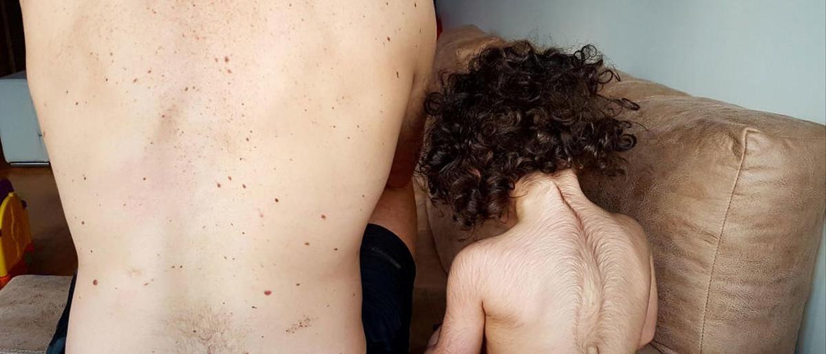 Una niña afectada por el falso omeprazol.