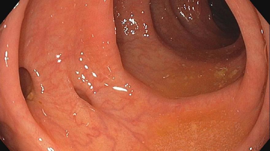 Esta es la bacteria relacionada con el aumento de casos de cáncer colorrectal entre los jóvenes