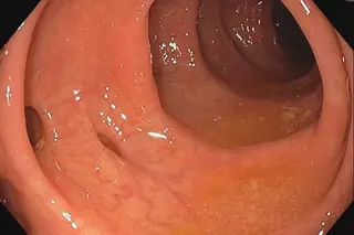 Joaquín Fernández, médico digestivo en Son Espases: "Casi todos desarrollamos divertículos en el colon con la edad, pero solo unos pocos tienen la enfermedad"