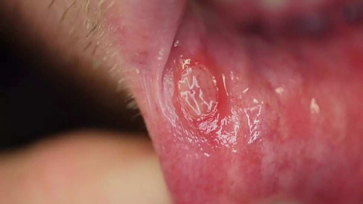 ¿Tienes llagas en la boca que no desaparecen? Podrían ser el primer síntoma del cáncer que no para de aumentar