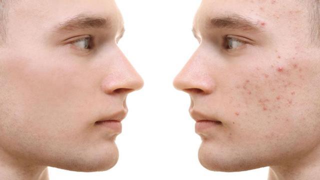 El factor hormonal es clave en la aparición de acné, muy habitual en la adolescencia. | SHUTTERSTOCK