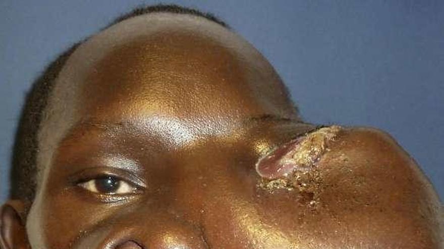 Cavadas opera a un keniata de un tumor gigante