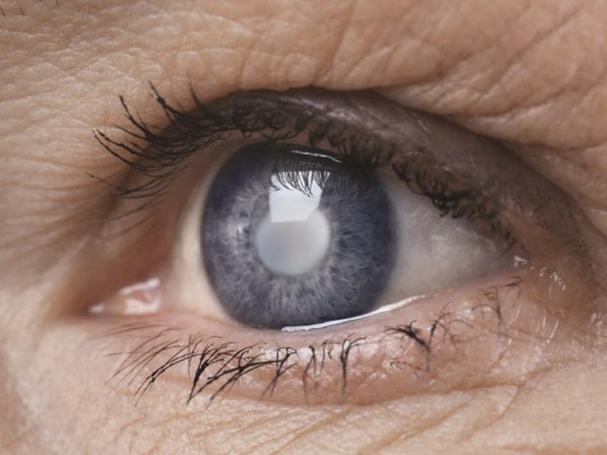 Detrás del velo de las Cataratas: síntomas, cirugía e innovación en lentes
