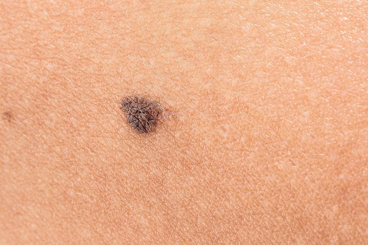 Quemaduras en la piel o daño celular son algunos de los peligros del sol.