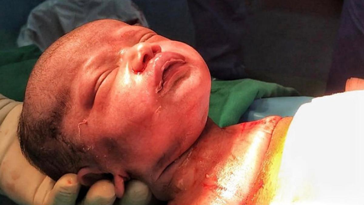 Un bebé nace por cesárea natural en Venezuela
