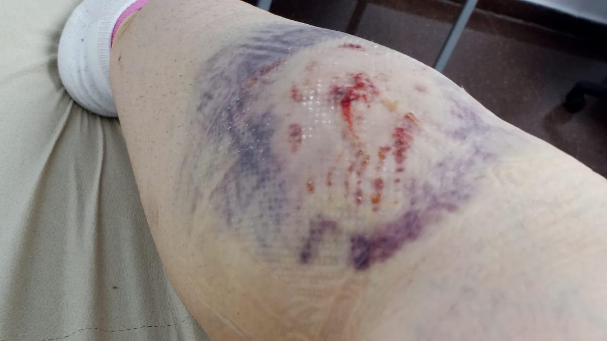 Las heridas causadas por los pitbulls en la pierna de la víctima, dos días después del ataque.