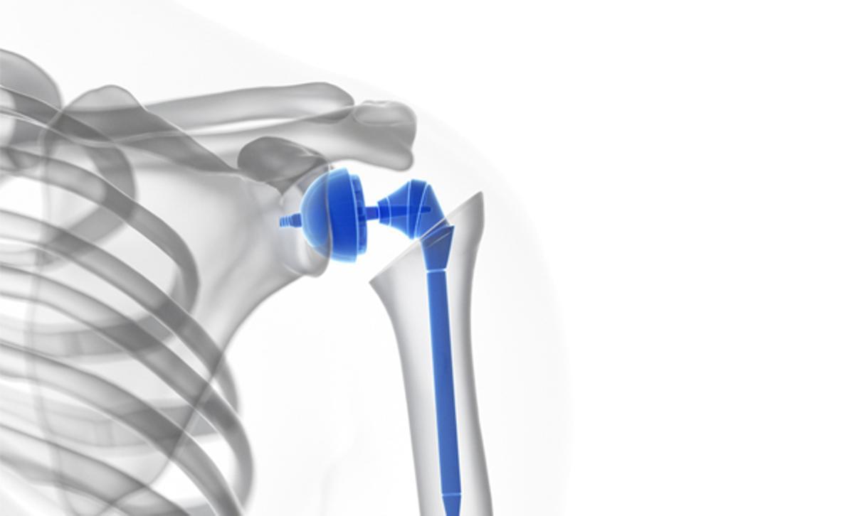 La prótesis de hombros consiste en una bola de metal que se introduce en la cabeza del húmero.