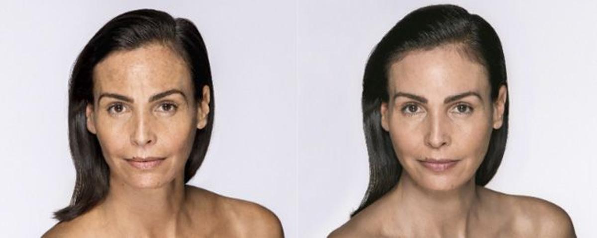 Antes y después de Inés Sastre mesoestetic