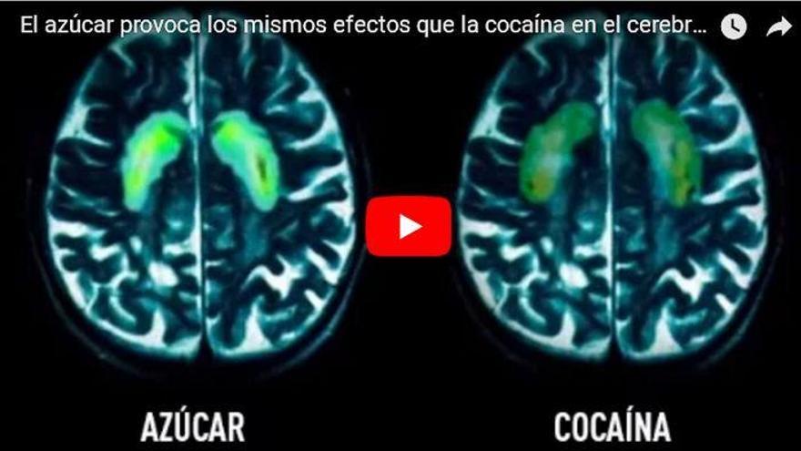 El consumo excesivo de azúcar daña al cerebro de una manera similar a como lo hace la cocaína