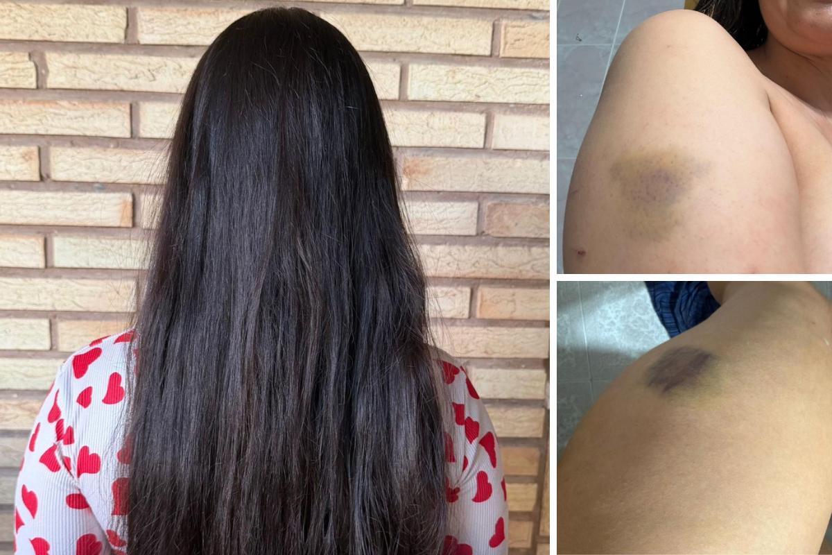 La víctima del secuestro en la caravana muestra sus hematomas.