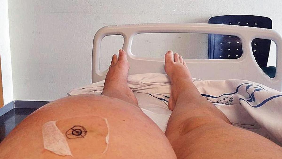 Estado de la pierna de la paciente cuando estaba ingresada en el Hospital Universitario Insular de Gran Canaria.