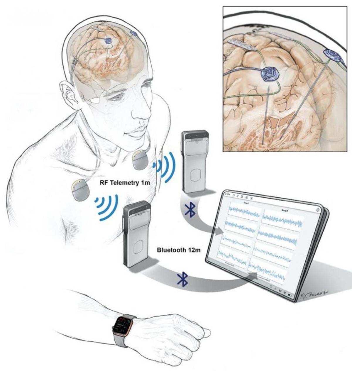 Una tecnología sin cables graba todo lo que pasa en el cerebro